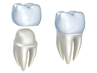 How To Choose the Best Dental Crown
