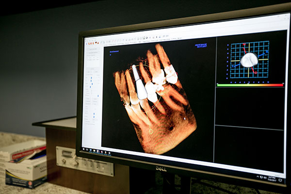 Video monitor with an Xray of a dental implant