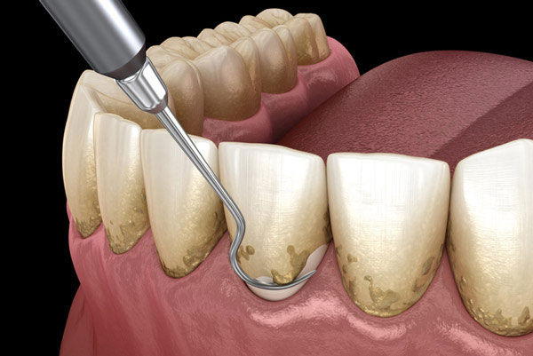 A diagram of dirty teeth getting cleaned