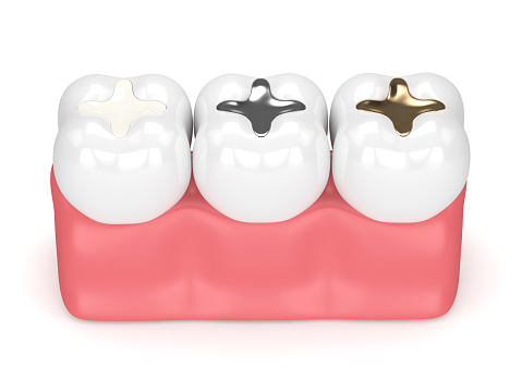 A diagram of dental fillings