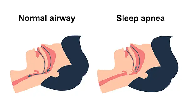 Diagram comparing a normal airway with a sleep apnea airway, illustrating how restricted airflow causes sleep disturbances.